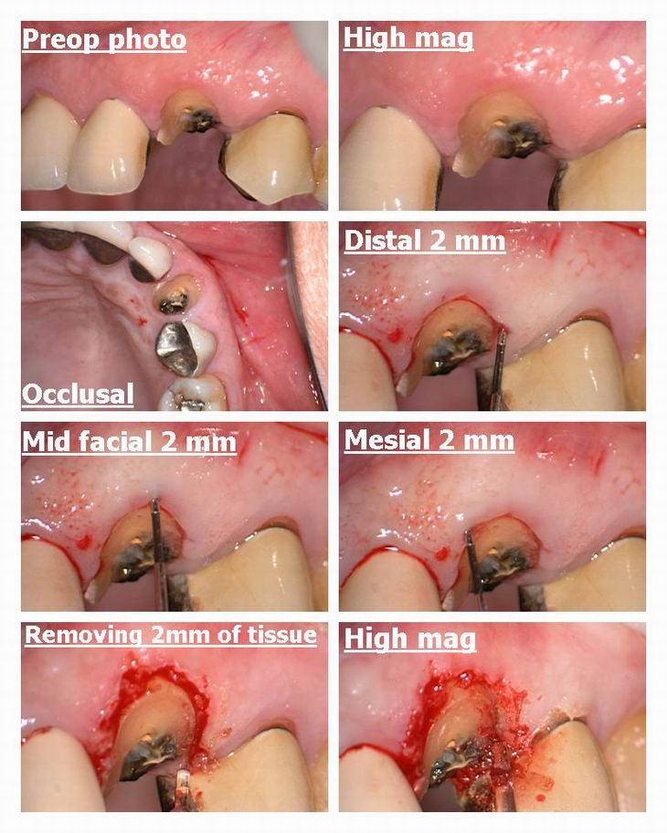 Resize of Osseous Recontouring on Canine pg 1.jpg